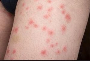 Bed Bug Bites Pictures: Arm, Face, Legs, Chest, Back & Babies • Pest ...