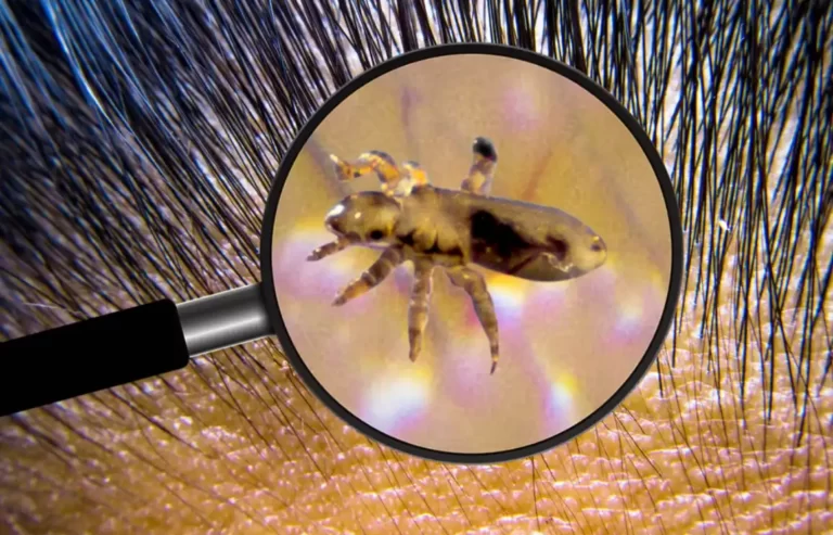 Lice are animals that feed on the blood of people on the scalp.