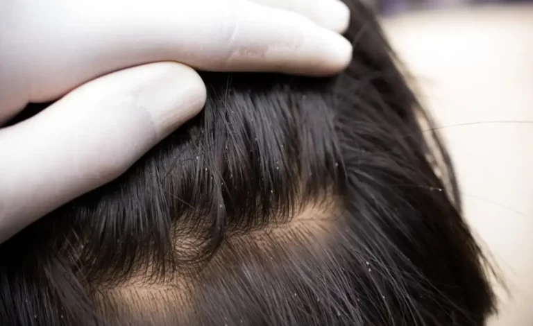 louse eggs. Lice eggs on the child's head cause head itching.