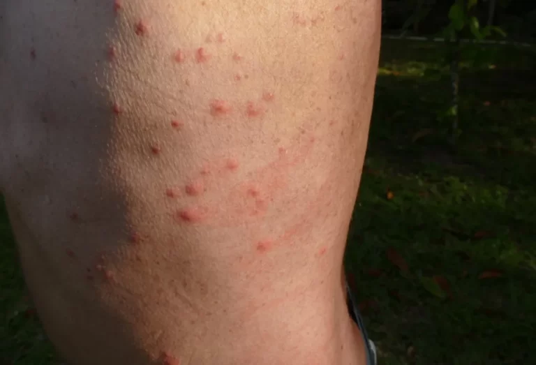 Bettwanzenstichstellen auf der Haut (Rücken)