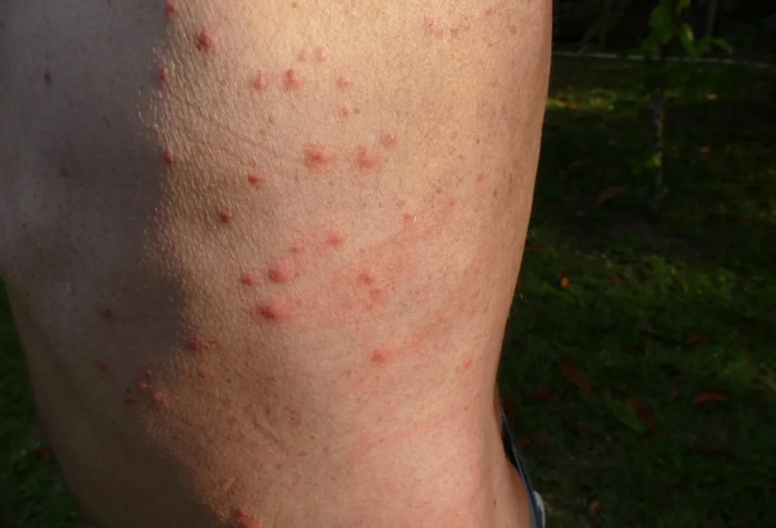 Bed Bug Bites Pictures: Arm, Face, Legs, Chest, Back & Babies 1 Bed bug bites marks on skin (back)