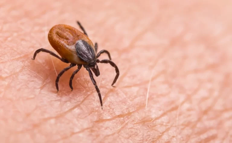 Infected female deer tick on hairy human skin. Ixodes ricinus