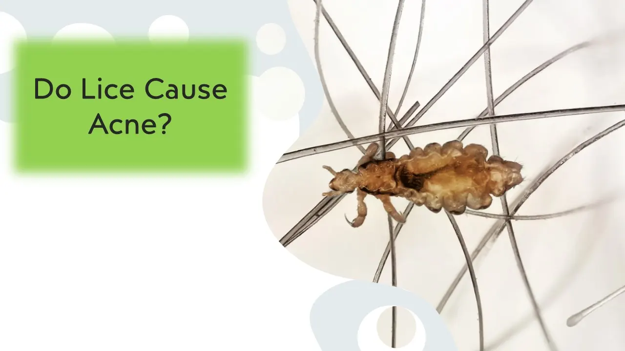 Do Lice Cause Acne? An Investigation into the Link Between the Two 1 Do Lice Cause Acne