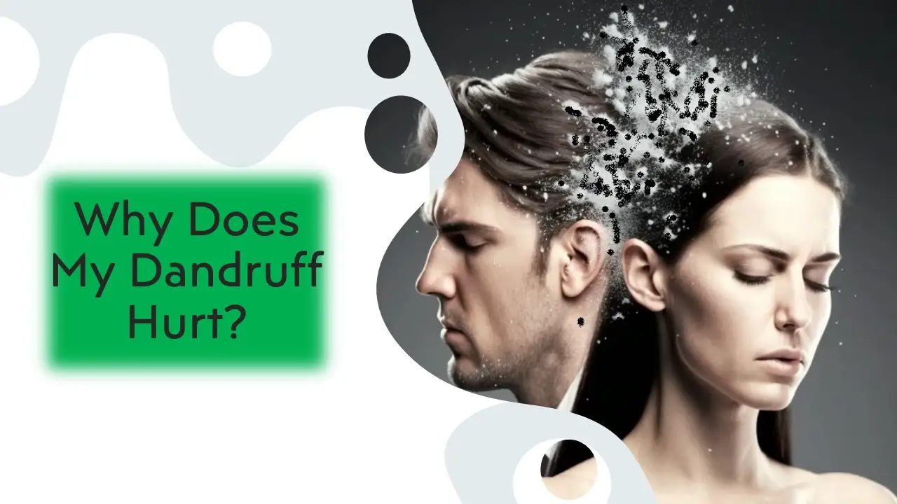 Why Does My Dandruff Hurt? 1 Why Does My Dandruff Hurt